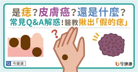 為什麼痣會長毛|是痣？皮膚癌？還是什麼？常見Q&A解惑！醫教揪出「假的痣」